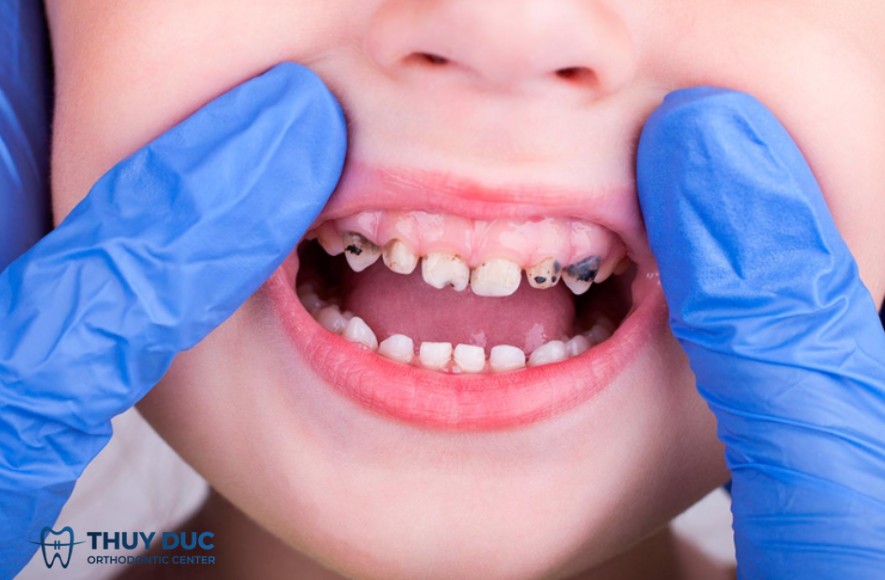 1. Siết răng răng ở trẻ em là gì? 1 1. Siết răng răng ở trẻ em là gì? 1