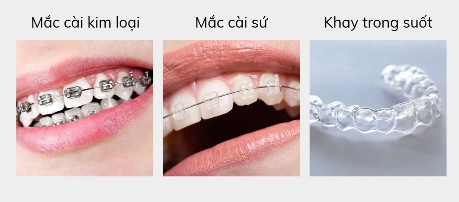 Các loại vật liệu niềng răng 1