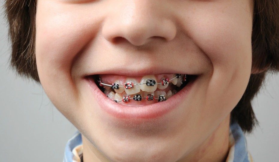 1.2. Nguyên lý của niềng răng 1