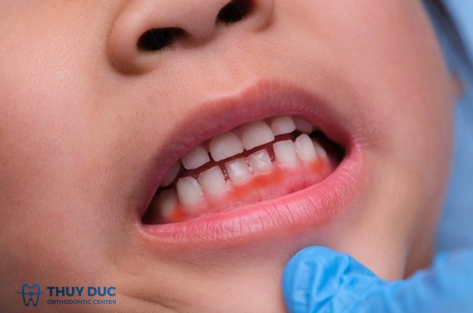 1. Viêm chân răng là gì? 1 1. Viêm chân răng là gì? 1