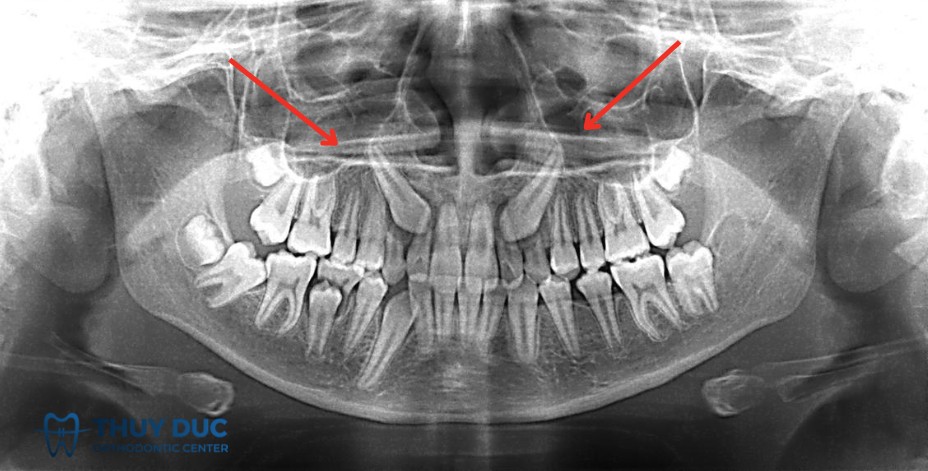 1. Khái niệm răng mọc ngầm 1 1. Khái niệm răng mọc ngầm 1