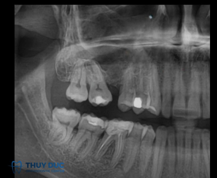 1. Răng bị nghiêng, đổ vào khoảng trống mất răng 1 1. Răng bị nghiêng, đổ vào khoảng trống mất răng 1