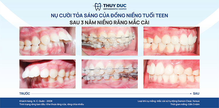 1. Niềng răng ảnh hưởng thế nào đến cấu trúc khuôn mặt? 1