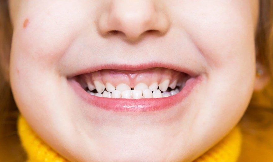 3.2 Bệnh nhân sai khớp cắn loại III 1