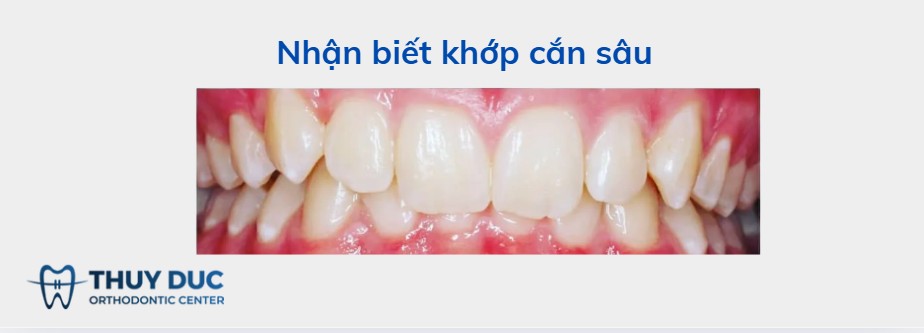 Thế nào là khớp cắn sâu? 1 Thế nào là khớp cắn sâu? 1