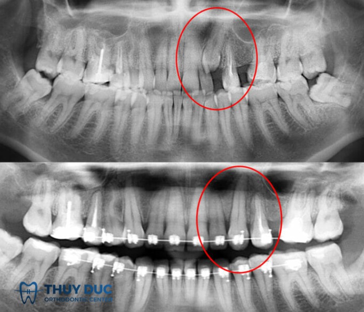 4.2 Kéo răng mọc ngầm bằng khí cụ chỉnh nha 1 4.2 Kéo răng mọc ngầm bằng khí cụ chỉnh nha 1