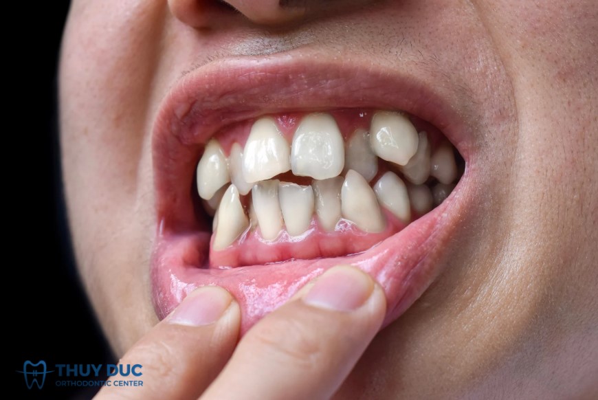 3. Răng mọc sai vị trí, xoay lệch hoặc chìa ra ngoài 1 3. Răng mọc sai vị trí, xoay lệch hoặc chìa ra ngoài 1