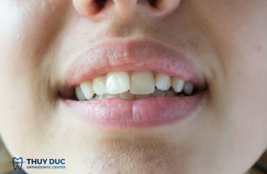 6. Phục hình thẩm mỹ vùng răng cửa nhưng không muốn mài nhiều mô răng 1 6. Phục hình thẩm mỹ vùng răng cửa nhưng không muốn mài nhiều mô răng 1