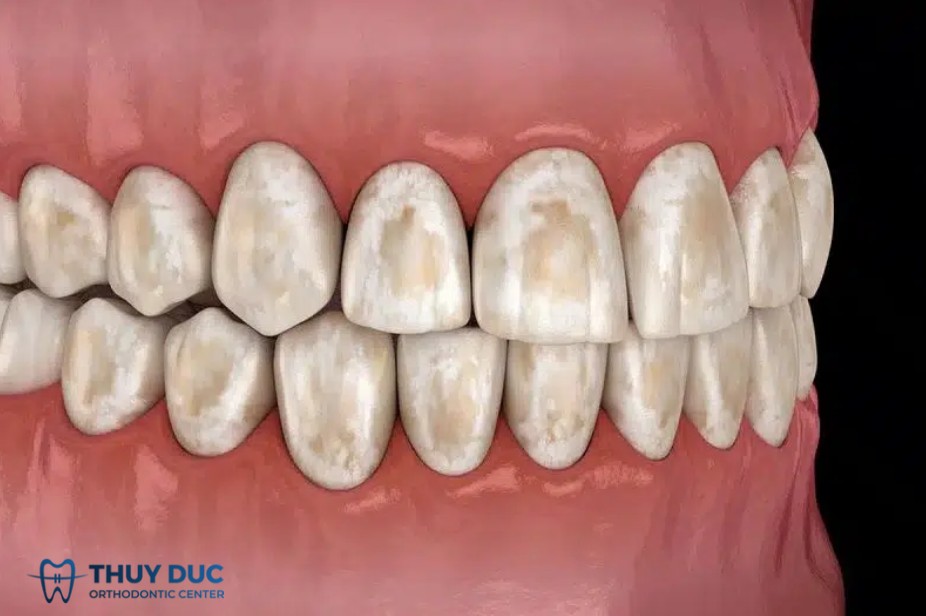 1.2. Nhiễm fluor quá mức (Fluorosis) 1 1.2. Nhiễm fluor quá mức (Fluorosis) 1