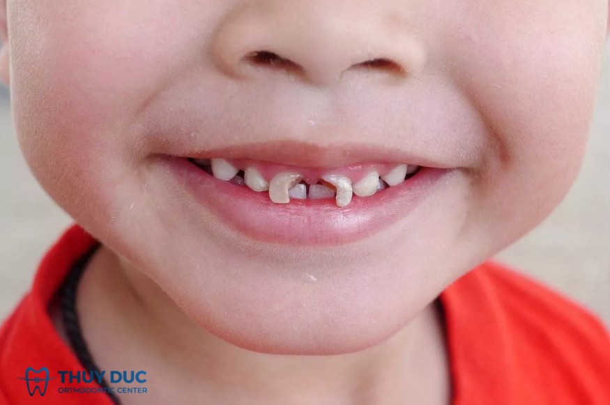 1. Siết răng răng ở trẻ em là gì? 2 1. Siết răng răng ở trẻ em là gì? 2