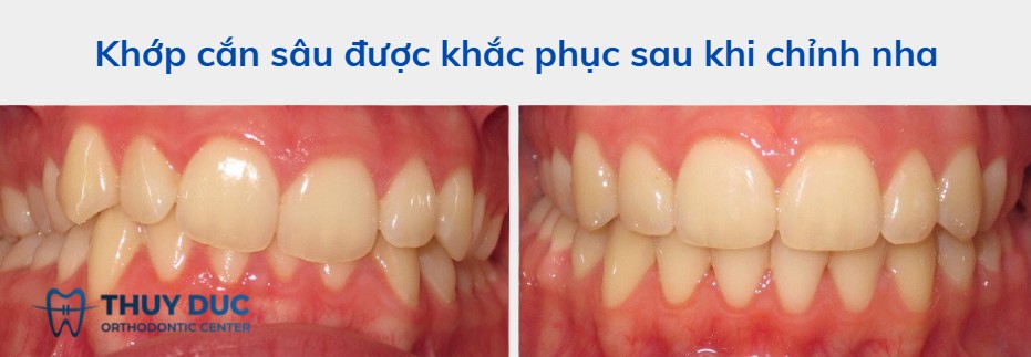 Các ảnh hưởng của khớp cắn sâu: Không chỉ là vấn đề thẩm mỹ 1 Các ảnh hưởng của khớp cắn sâu: Không chỉ là vấn đề thẩm mỹ 1