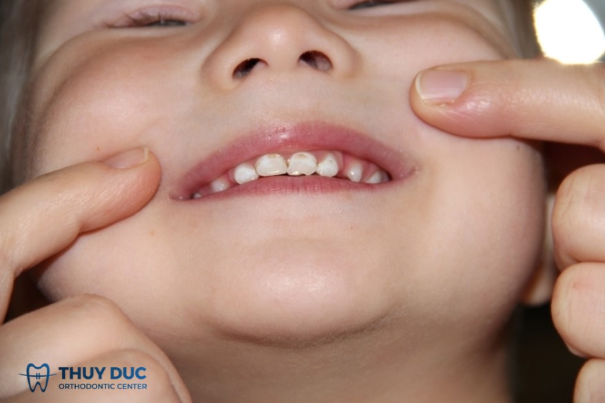 1. Thiểu sản men răng 1 1. Thiểu sản men răng 1