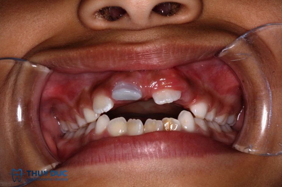 2. Phân loại mức độ vỡ răng của trẻ 1 2. Phân loại mức độ vỡ răng của trẻ 1