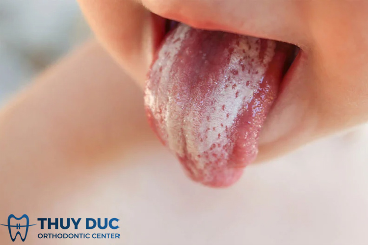 3. Nấm miệng (Tưa lưỡi) 1 3. Nấm miệng (Tưa lưỡi) 1