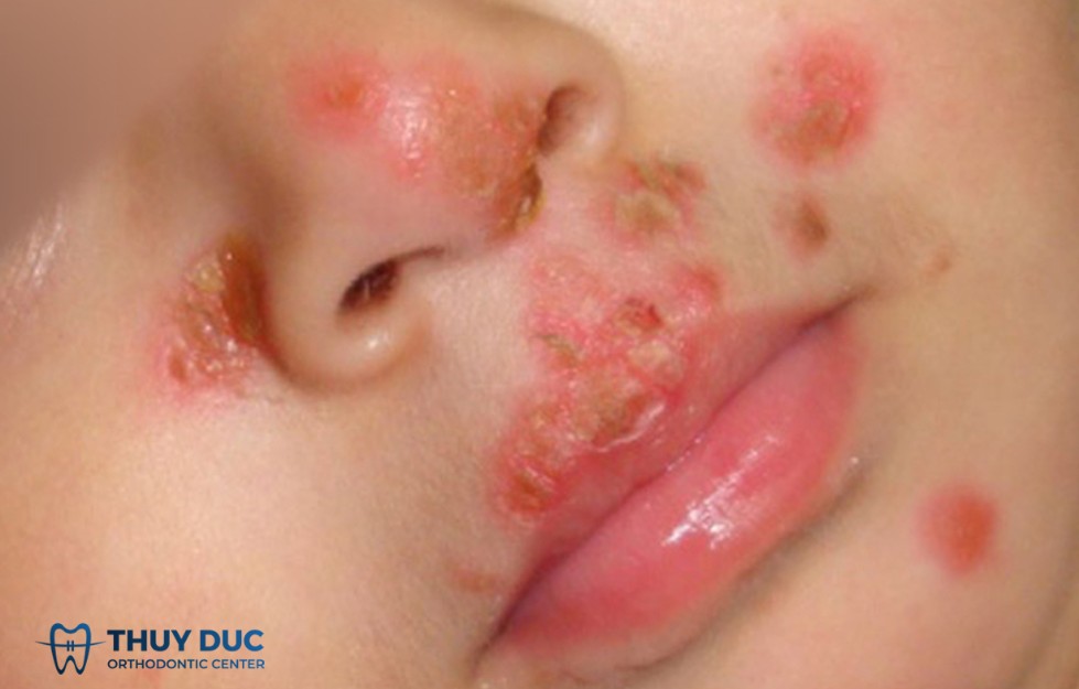 1.1 Viêm niêm mạc miệng do virus 1 1.1 Viêm niêm mạc miệng do virus 1
