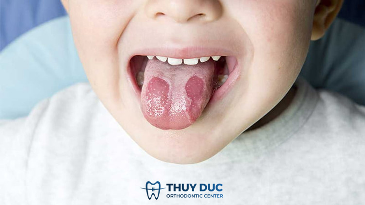 4. Viêm lưỡi bản đồ 1 4. Viêm lưỡi bản đồ 1